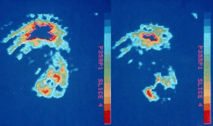 Image: PET scan of the human heart showing the effect of a blood clot (Photo courtesy of Science Source).